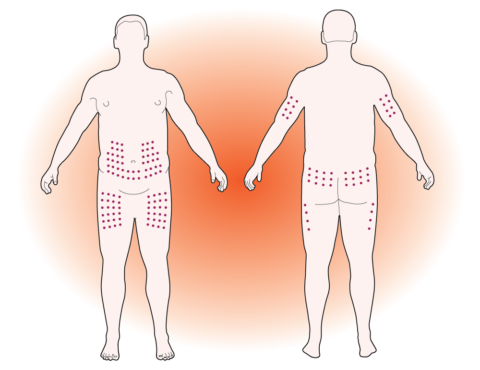 Diabetes injection - good locations on the body include the abdomen, the buttocks and outer thighs, and the back of the upper arms
